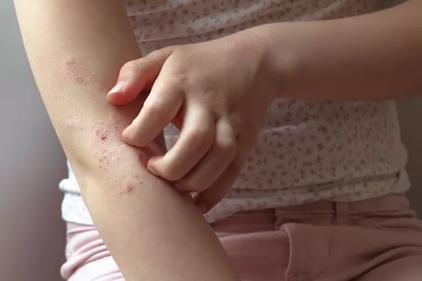 Eczema could soon be treated with a vaccine as scientists make breakthrough