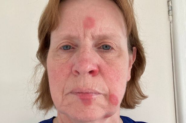 Woman left with red blotches on face after opening air freshener