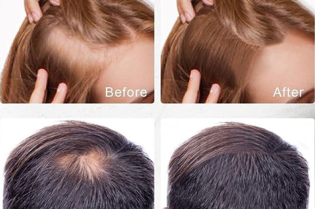 Amazon slashes price of ‘miracle’ hair growth spray that works in just two weeks